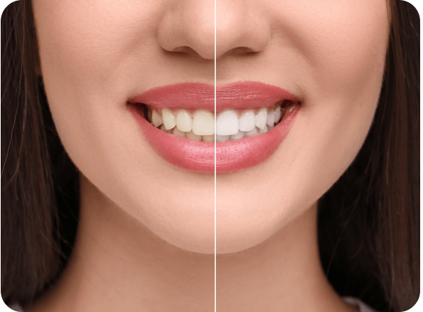 Zahnaufhellung-vorher-nachher