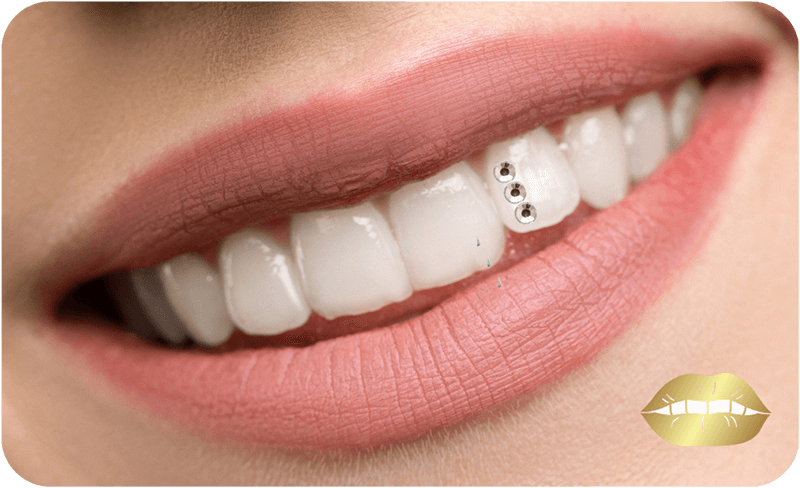 Zahnschmuck-Standard